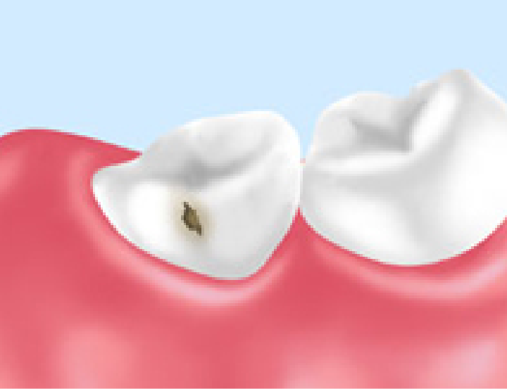 墨田区東向島の歯医者、トータス歯科クリニックのむし歯治療