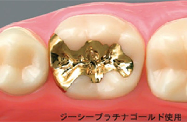 墨田区東向島の歯医者、トータス歯科クリニックのゴールドインレー