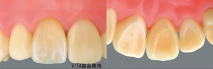 墨田区東向島の歯医者、トータス歯科クリニックのオールセラミッククラウン
