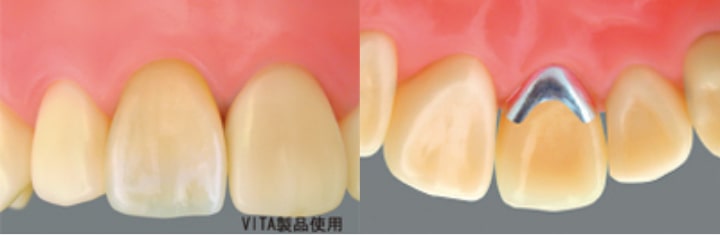 墨田区東向島の歯医者、トータス歯科クリニックのメタルボンド（内側が金属）