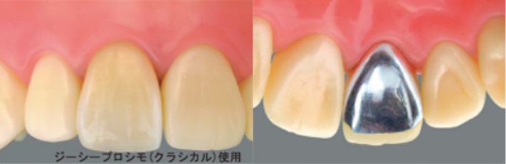 墨田区東向島の歯医者、トータス歯科クリニックの硬質レジンクラウン