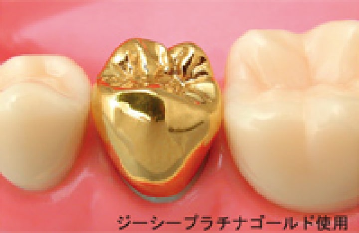 墨田区東向島の歯医者、トータス歯科クリニックのゴールドクラウン