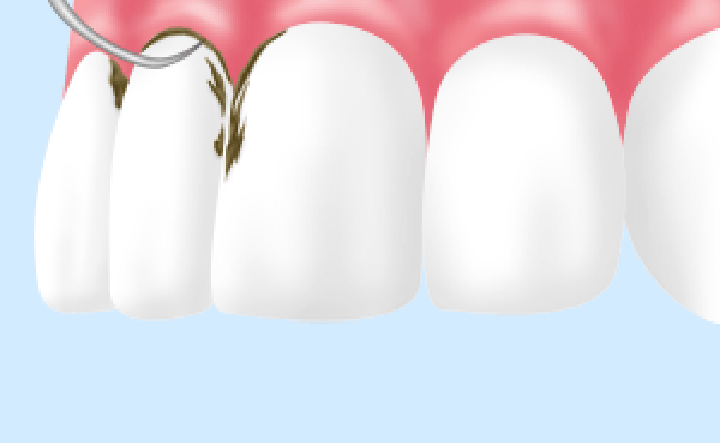 墨田区東向島の歯医者、トータス歯科クリニックの歯周病治療